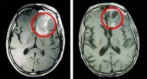 Brain cancer - cauze, simptome, tratament