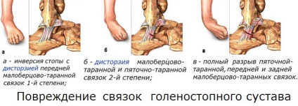 Stretching ligamentele articulației glezne - cum să tratăm