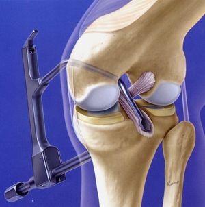 Ruperea ligamentului (ligamentelor) cruciat posterior