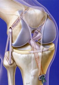 Ruperea ligamentului (ligamentelor) cruciat posterior