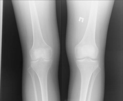 Roentgen al articulației genunchiului