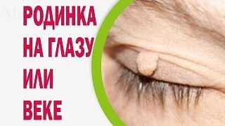 Родимка на оці або столітті особливості, лікування, видалення