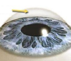 Corneea ochiului - structura și funcția, diagnosticul și boala - site-ul - oftalmologie Moscova