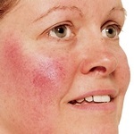 Rosacea, online ásványi kozmetikumok 