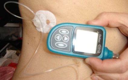 Diabetul zaharat la copii, cauze, simptome, tratament