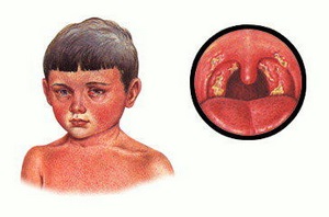 Simptomele și cauzele anginei la copii de particularitățile cursului de diferite forme