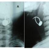 Simptomele prezenței unui corp străin în bronhiile unui copil - medicul dumneavoastră aibolit