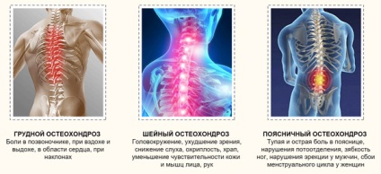 Simptomele osteocondrozei coloanei vertebrale, toracice, lombare, tratamentul osteocondrozei