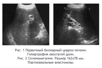 A májcirrhosis tünetei a férfiakban, hogyan kell kezelni