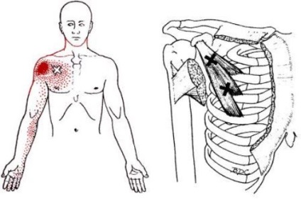 гръдния синдром непълнолетен мускул - симптоми и лечение