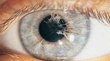 Synechia cauzează ochi, simptome și tratament