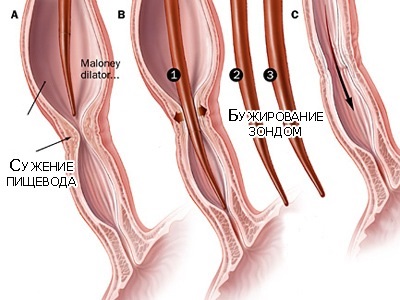 Spasmul cauzat de esofag, diagnostic, tratament