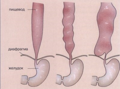 Spasmul cauzat de esofag, diagnostic, tratament