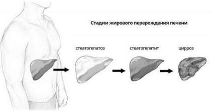 Steatomatomatoza - care sunt simptomele și tratamentul steatohepatozelor