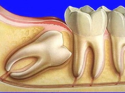 Indiferent dacă este necesar să tratăți dinții de înțelepciune sau mai bine să le eliminați, consultăm medicii stomatologi