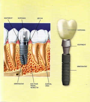 Stomatologie - medicul dentist, implantarea dinților într-un cerzan