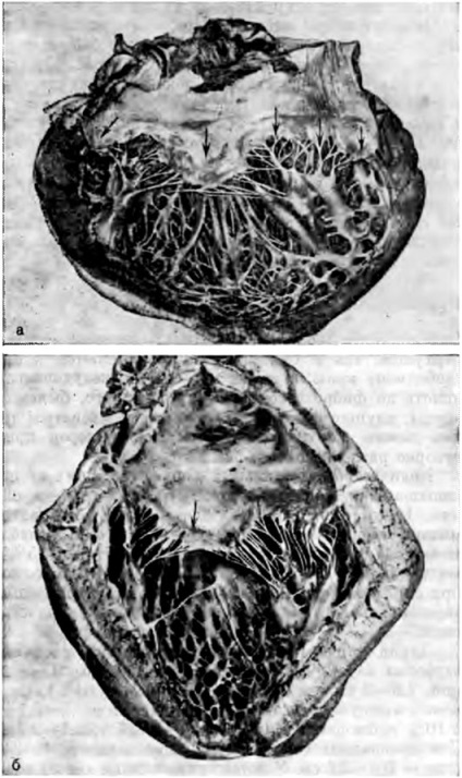 Supapele valvei atrioventriculare stângi - anatomia clinică a inimii