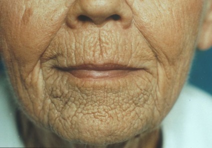 Tipurile de îmbătrânire a feței și caracteristicile acestora, exemple, fotografii