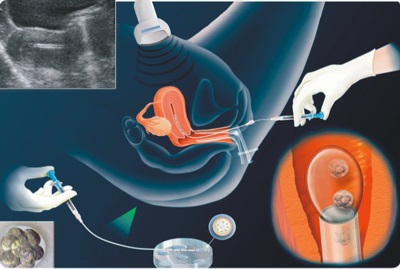 Ultrahangos hysterosalpingoscopy, Novomeditsin-Medical Center