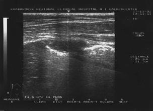 Imaginea ultrasonică a efuziunii pleurale libere