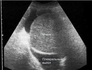 Imaginea ultrasonică a efuziunii pleurale libere