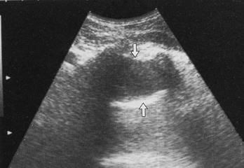 Imaginea ultrasonică a efuziunii pleurale libere