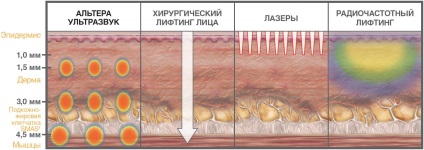 Lifting ultrasonic (ulthera) - clinica profesorului Yutzkowska