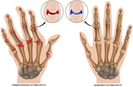Exerciții pentru tratamentul artritei degetelor