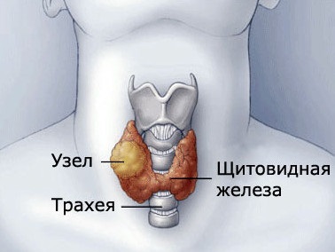 възли на щитовидната жлеза симптоми