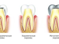 Tipuri de coroane dentare