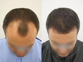Căderea părului după transplant ce trebuie făcut, consecințele transplantului de păr nereușit