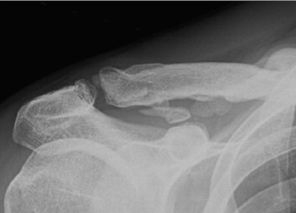 Dislocarea clinicii claviculare, diagnostic, tratament, medjournal