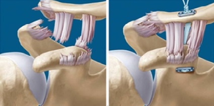 Dislocarea clinicii claviculare, diagnostic, tratament, medjournal