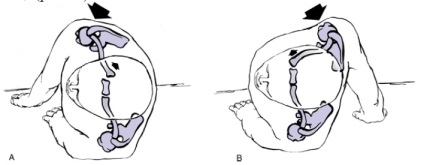 Dislocarea clinicii claviculare, diagnostic, tratament, medjournal