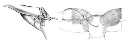 Dislocarea clinicii claviculare, diagnostic, tratament, medjournal