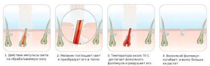 Totul despre fotoepilare și tehnologia ipl