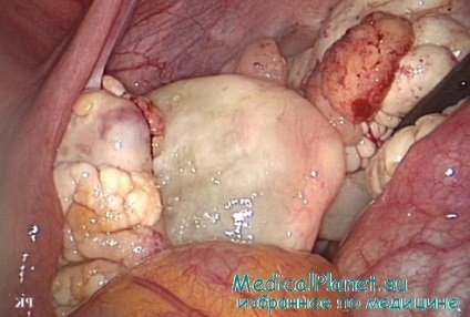Tratamentul chirurgical al tumorilor ovariene