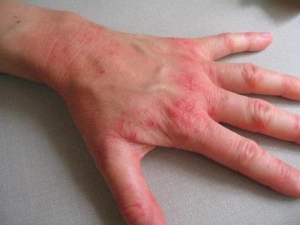 Alergiile la frig pe mâini și picioare simptome foto și tratament