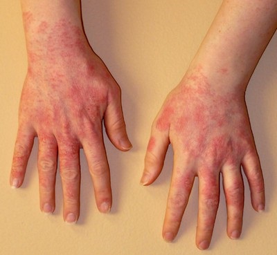 Alergiile la frig pe mâini și picioare simptome foto și tratament