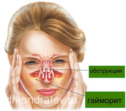 Заболявания на максиларния синус, д-р Kondratyev