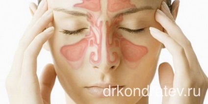 Boli ale sinusului maxilar, Dr. Kondratev