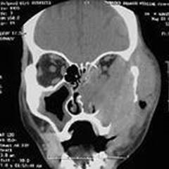 Neoplasm malign al simptomelor cavității nazale, tratament