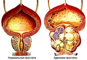 Adenomul glandei prostatei la bărbați, tratamentul medicamentelor folclorice de prostată, ce ierburi sunt cel mai mult