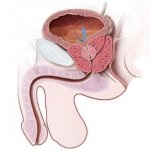 Adenomul prostatei