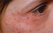 Napi allergia vagy fotodermitisz