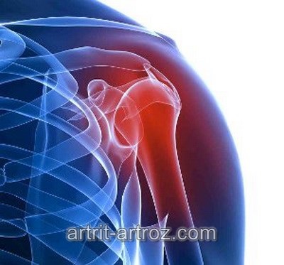 Artrita simptomelor articulațiilor umărului și tratamentul bolii