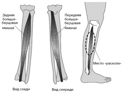 Sindromul stresului tibial (bbss)