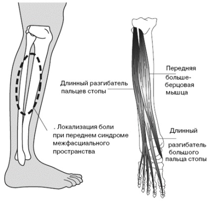 Sindromul stresului tibial (bbss)