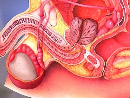 Care este picatura scrotului la bărbați semne de testicul hidrocelcel, simptome ale bolii, tratament și fotografii