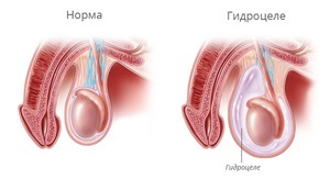 Care este picatura scrotului la bărbați semne de testicul hidrocelcel, simptome ale bolii, tratament și fotografii